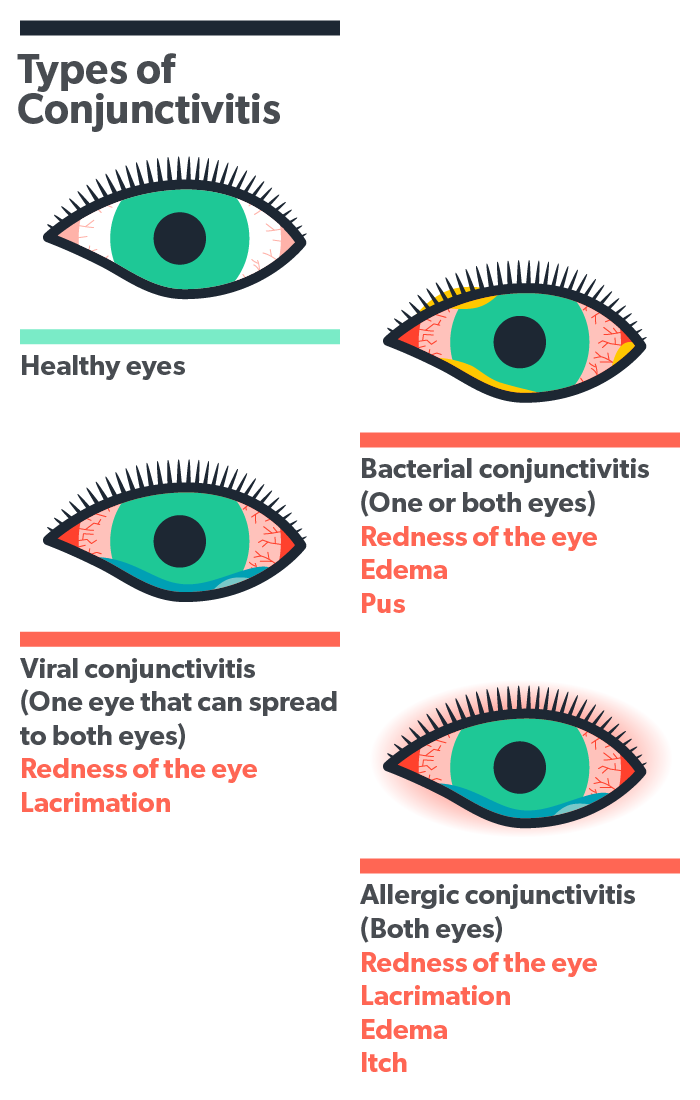 allergic-conjunctivitis