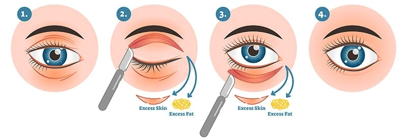 Blepharoplasty-procedure