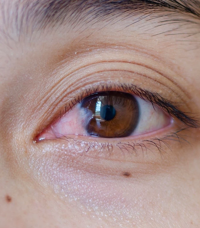 Pterygium-Surgery-boca-raton